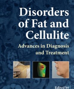 Disorders of Fat and Cellulite: Advances in Diagnosis and Treatment