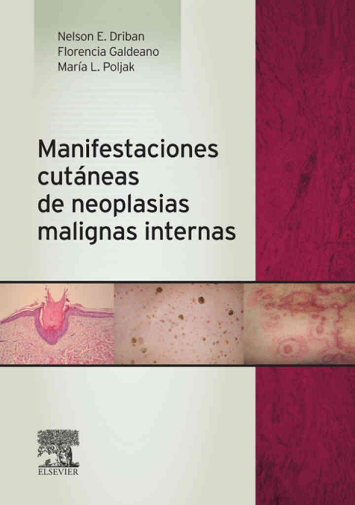 Manifestaciones cut�neas de neoplasias malignas internas